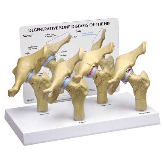 4-Stage Degenerative Bone Diseases of the Hip