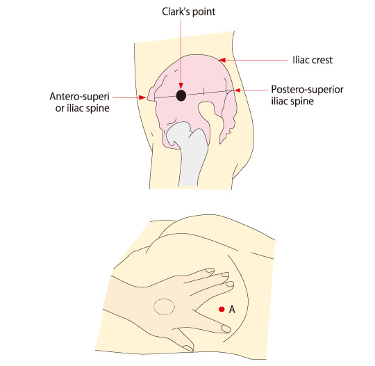 Gluteal Intramuscular Injection Model Type Ⅱ - Live Wire Learning
