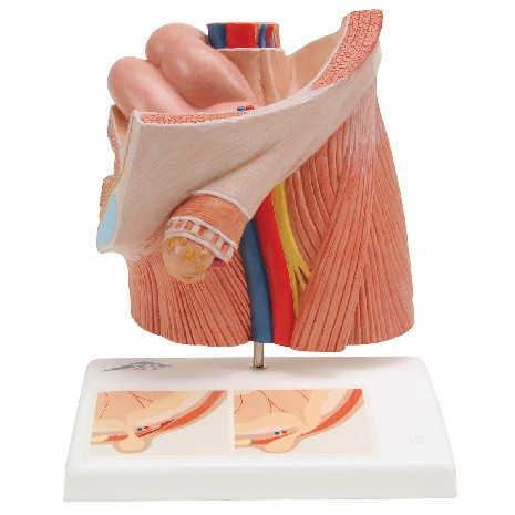 INGUINAL HERNIA MODEL 100284 (H130)